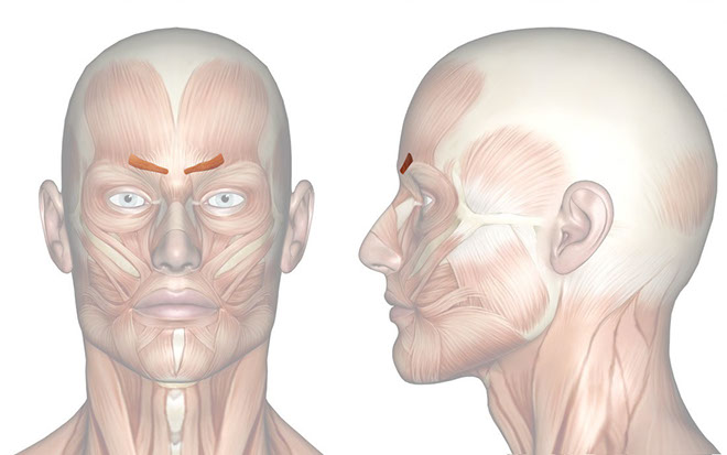 Patakara.eu - Músculo corrugador superciliar. Patakara.eu - Musculus corrugator supercilii.